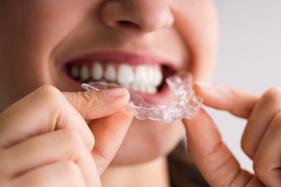 This is a thumbnail image of blog 5 Questions to Ask Before Choosing a Clear Aligner Provider